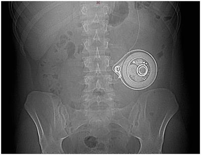 Unexpected Acceleration in Treprostinil Delivery Administered by a Lenus Pro® Implantable Pump in Two Patients Treated for Pulmonary Arterial Hypertension